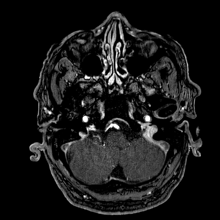 Accessory middle cerebral artery (Radiopaedia 73114-83828 Axial MRA 21).jpg
