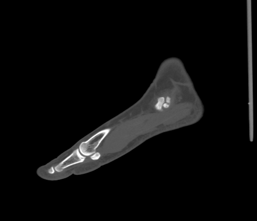 File:Accessory navicular bone (Radiopaedia 54999-61314 Sagittal non-contrast 18).jpg