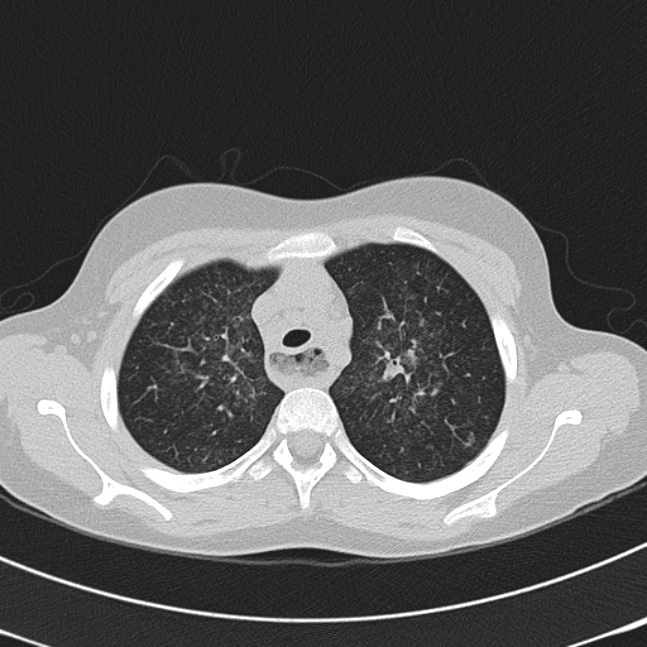 Achalasia (Radiopaedia 14946-14878 Axial lung window 16).jpg