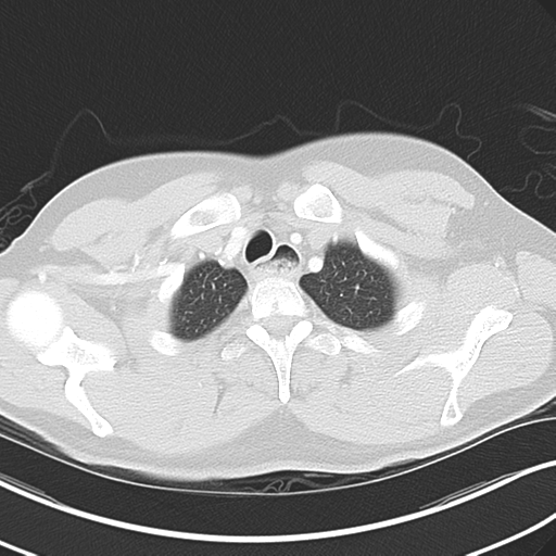 Achalasia of the cardia (Radiopaedia 38497-40595 Axial lung window 8).png
