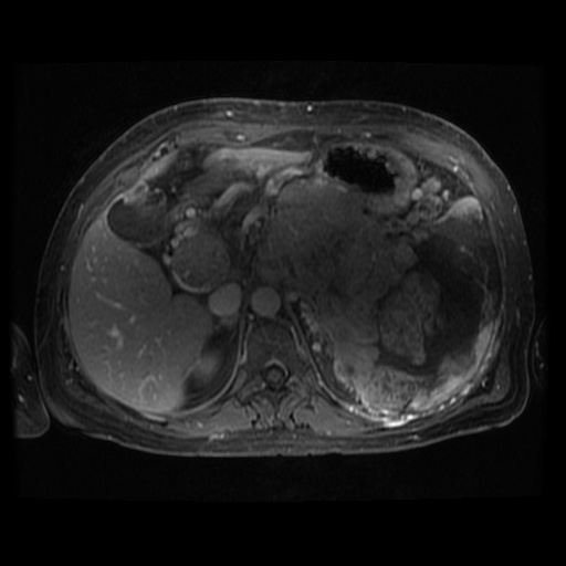 Acinar cell carcinoma of the pancreas (Radiopaedia 75442-86668 Axial T1 C+ fat sat 78).jpg