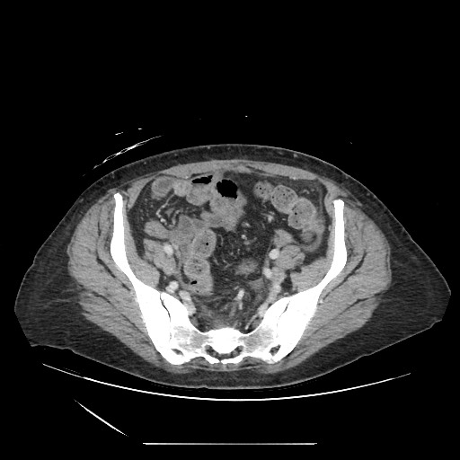 Acinar cell carcinoma of the pancreas (Radiopaedia 75442-86669 Axial C+ portal venous phase 115).jpg