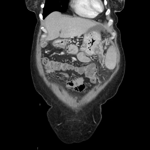 Acinar cell carcinoma of the pancreas (Radiopaedia 75442-86669 Coronal C+ portal venous phase 27).jpg