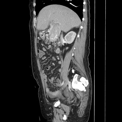 Acinar cell carcinoma of the pancreas (Radiopaedia 75442-86669 Sagittal C+ portal venous phase 76).jpg