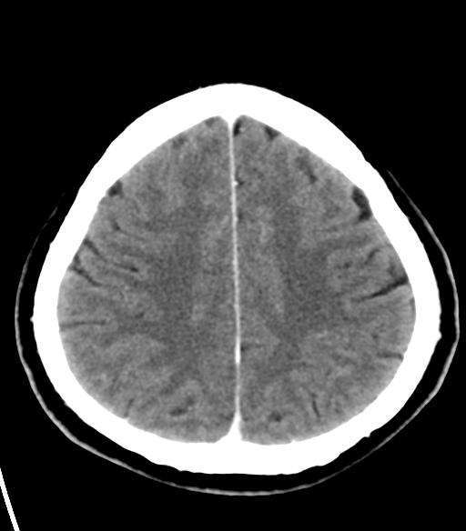 File:Acoustic schwannoma (Radiopaedia 33045-34065 Axial C+ delayed 21).png