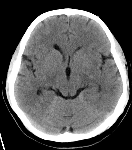 File:Acoustic schwannoma (Radiopaedia 33045-34065 Axial non-contrast 11).png