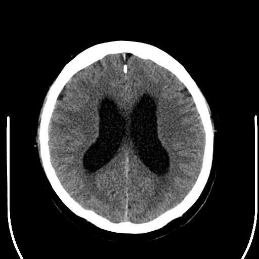 File:Acoustic schwannoma (Radiopaedia 39170-41389 Axial non-contrast 18).png