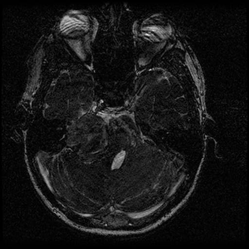 Acoustic schwannoma - eroding petrous apex (Radiopaedia 39674-42004 Axial T2 51).png