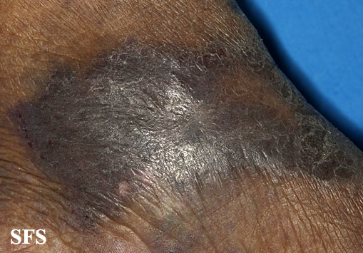 File:Acroangiodermatitis (Dermatology Atlas 4).jpg