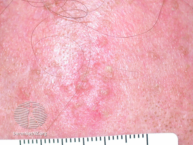 Actinic Keratoses affecting the face (DermNet NZ lesions-ak-face-511).jpg