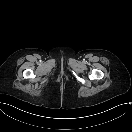 Active Crohn disease (Radiopaedia 59394-66750 Axial C+ portal venous phase 78).jpg