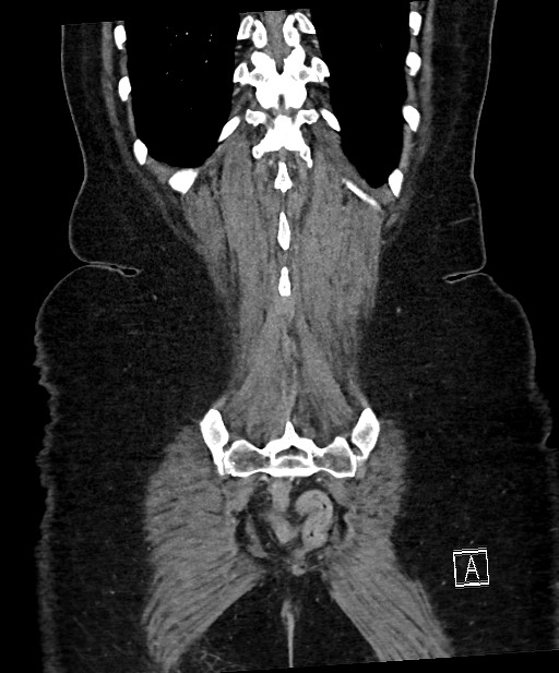 Active Crohn disease (Radiopaedia 59394-66750 Coronal C+ portal venous phase 60).jpg