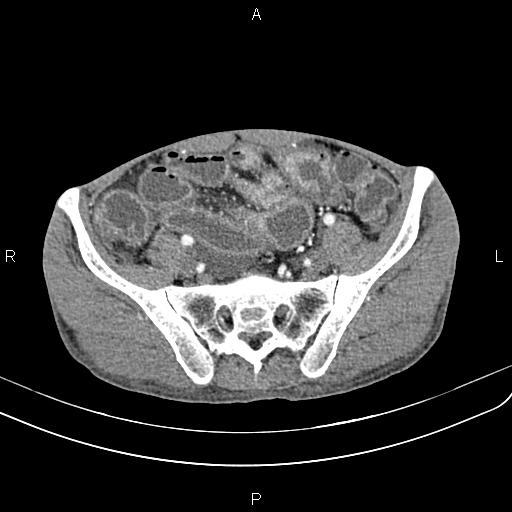 Active crohn disease (Radiopaedia 87133-103397 Axial C+ arterial phase 79).jpg