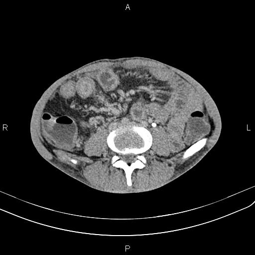 Active crohn disease (Radiopaedia 87133-103397 Axial C+ delayed 38).jpg
