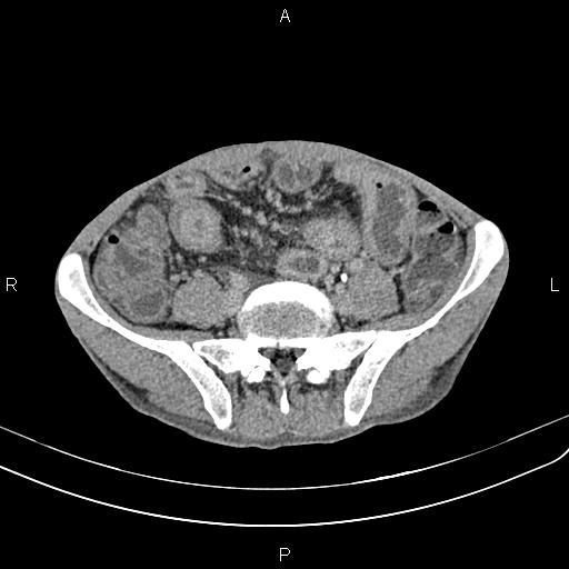 Active crohn disease (Radiopaedia 87133-103397 Axial C+ delayed 48).jpg