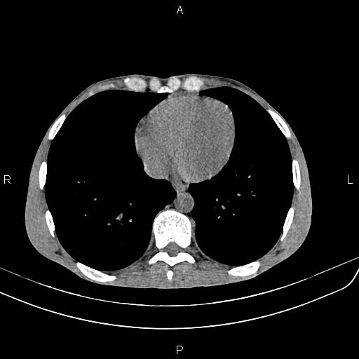 Active crohn disease (Radiopaedia 87133-103397 Axial non-contrast 2).jpg