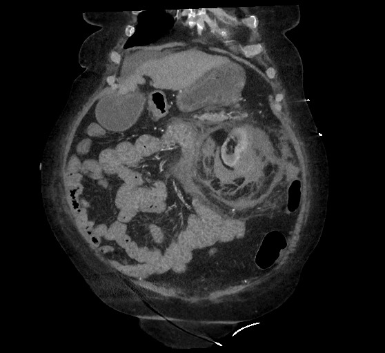 Active renal extravasation with large subcapsular and retroperitoneal hemorrhage (Radiopaedia 60975-68796 Coronal C+ arterial phase 45).jpg