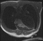 File:Active right ventricular cardiac sarcoidosis (Radiopaedia 55596-62100 Axial Dynamic perfusion scan MOCO 27).jpg
