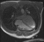 Active right ventricular cardiac sarcoidosis (Radiopaedia 55596-62100 Axial Dynamic perfusion scan MOCO 85).jpg