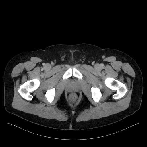 Acute-on-chronic pancreatitis (Radiopaedia 67286-76656 Axial C+ portal venous phase 85).jpg