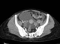 File:Acute Budd-Chiari syndrome (Radiopaedia 60858-68638 A 243).jpg