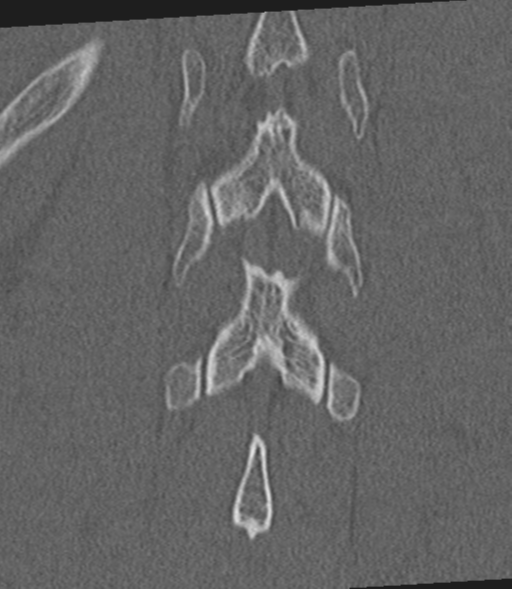 Acute L1 burst compression fracture (Radiopaedia 34430-35755 Coronal bone window 49).png