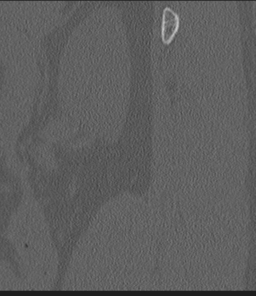 Acute L1 burst compression fracture (Radiopaedia 34430-35755 Sagittal bone window 3).png