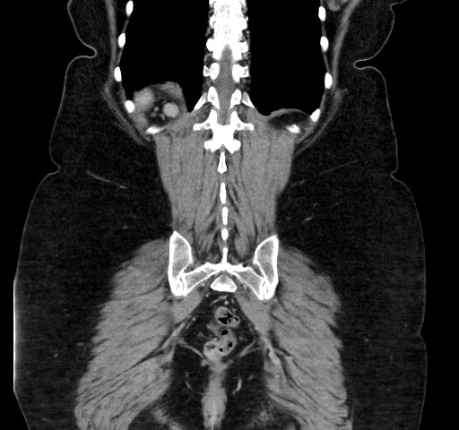 Acute appendicitis, heterotaxy syndrome (Radiopaedia 66884-76202 Coronal C+ portal venous phase 102).jpg