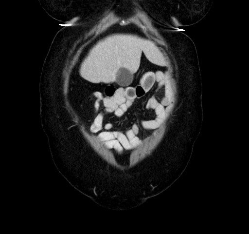 Acute appendicitis, heterotaxy syndrome (Radiopaedia 66884-76202 Coronal C+ portal venous phase 17).jpg