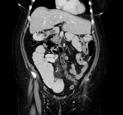 Acute appendicitis, heterotaxy syndrome (Radiopaedia 66884-76202 Coronal C+ portal venous phase 42).jpg