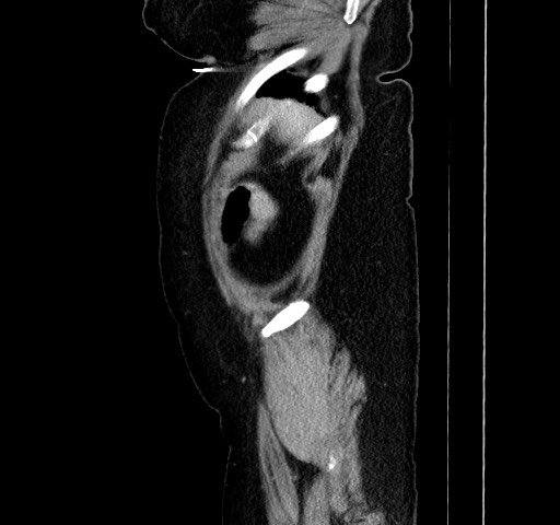 Acute appendicitis, heterotaxy syndrome (Radiopaedia 66884-76202 Sagittal C+ portal venous phase 116).jpg