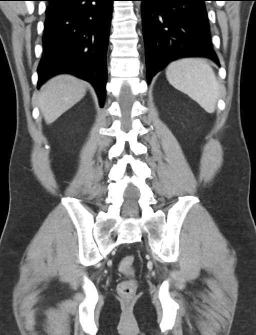 Acute appendicitis (Radiopaedia 36611-38177 Coronal C+ portal venous phase 47).png