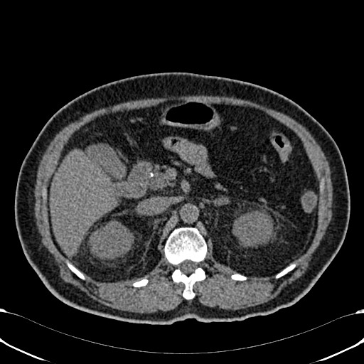 File:Acute appendicitis (Radiopaedia 58627-65818 Axial non-contrast 30).jpg