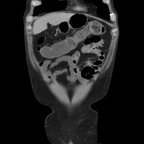 Acute appendicitis (Radiopaedia 66513-75790 Coronal C+ portal venous phase 2).jpg