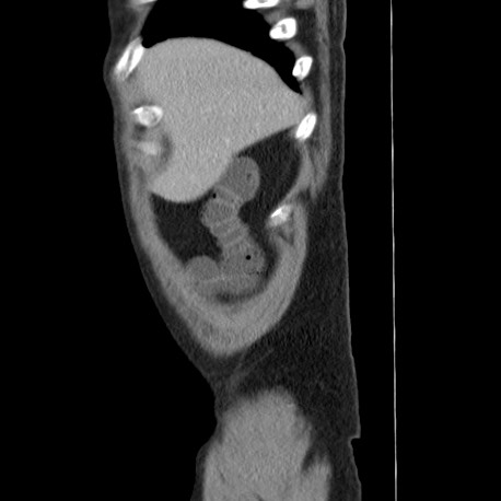 Acute appendicitis (Radiopaedia 66513-75790 Sagittal C+ portal venous phase 8).jpg