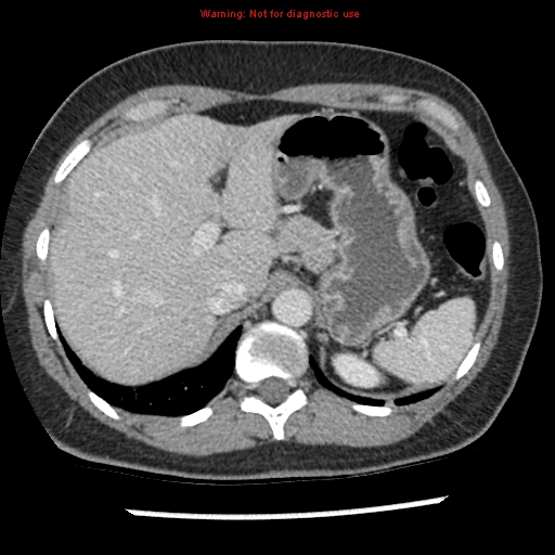 File:Acute appendicitis (Radiopaedia 7966-8812 C+ portal venous phase 4).jpg