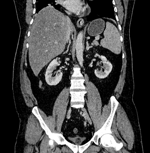 Acute appendicitis (Radiopaedia 79950-93224 Coronal C+ portal venous phase 54).jpg