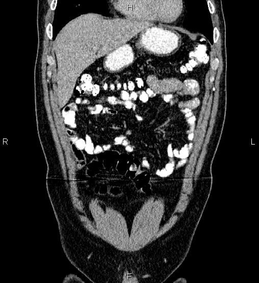 Acute appendicitis (Radiopaedia 84780-100240 Coronal C+ portal venous phase 18).jpg