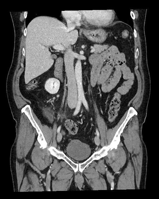 Acute appendicitis - large appendicoliths (Radiopaedia 61805-69820 Coronal C+ portal venous phase 65).jpg