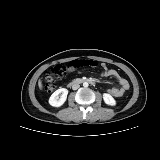 Acute appendicitis and COVID 19 pneumonia (Radiopaedia 76604-88380 Axial C+ portal venous phase 38).jpg