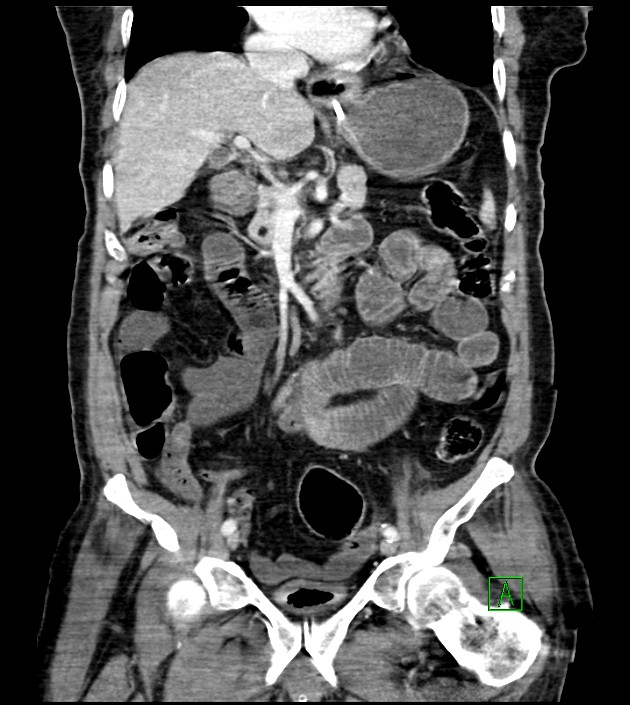 Acute arterial mesenteric ischemia (Radiopaedia 78238-90828 Coronal C+ portal venous phase 46).jpg