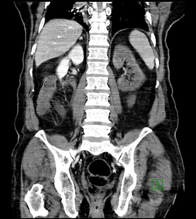 Acute arterial mesenteric ischemia (Radiopaedia 78238-90828 Coronal C+ portal venous phase 64).jpg