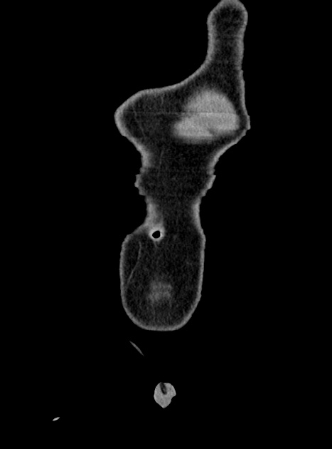Acute bowel ischemia (Radiopaedia 87695-104114 Coronal C+ portal venous phase 56).jpg