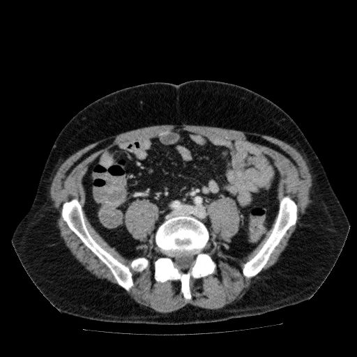 File:Acute cholecystitis and incidental left sided IVC (Radiopaedia 49352-54459 Axial C+ portal venous phase 103).jpg