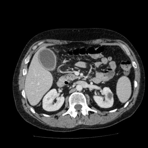 Acute cholecystitis and incidental left sided IVC (Radiopaedia 49352-54459 Axial C+ portal venous phase 62).jpg
