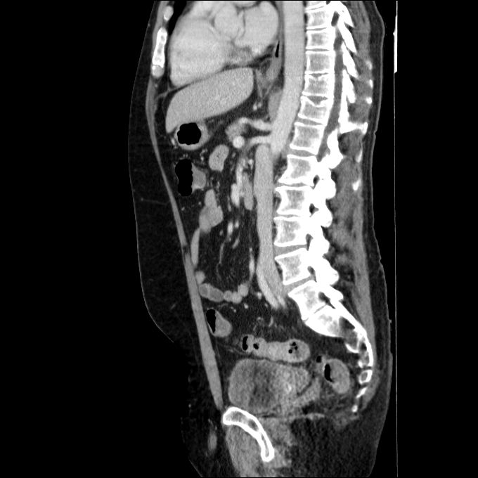 Acute cholecystitis and incidental left sided IVC (Radiopaedia 49352-54459 Sagittal C+ portal venous phase 43).jpg