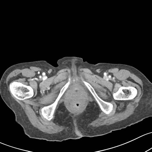 File:Acute cholecystitis with contained perforation (Radiopaedia 47328-51907 Axial C+ portal venous phase 78).png