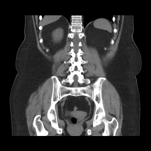 Acute cholecystitis with tensile fundus sign (Radiopaedia 71394-81723 Coronal non-contrast 88).jpg