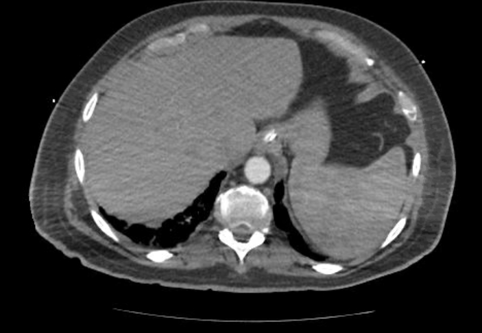 Acute cor pulmonale (ultrasound) (Radiopaedia 83508-98818 Axial C+ CTPA 75).jpg