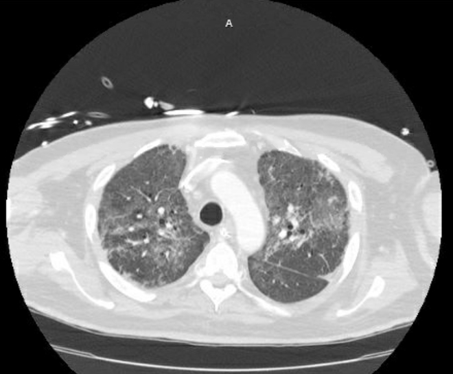 Acute cor pulmonale (ultrasound) (Radiopaedia 83508-98818 Axial lung window 26).jpg